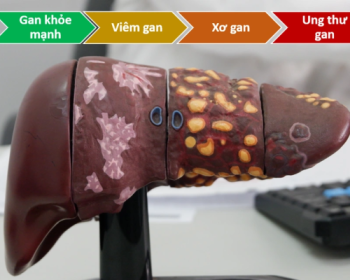 TỈ LỆ MẮC BỆNH UNG THƯ Ở VIỆT NAM RẤT CAO :